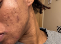 Does Diet Cause Acne? What the Research Actually Shows