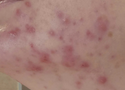 Adult Acne: Why It Happens After 25 and How to Treat It