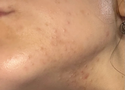 Does Stress Cause Acne? The Science Behind Stress Breakouts