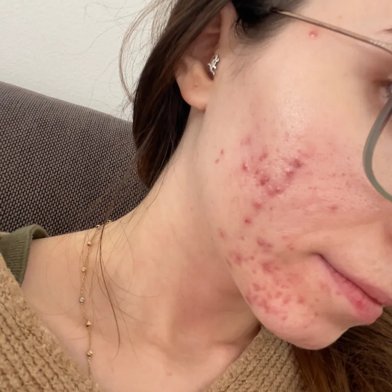 Woman with acne