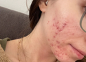 What Is Acne Vulgaris? Types, Causes and How to Treat It