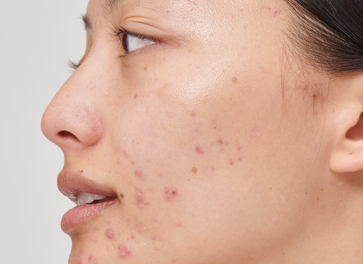 What Type Of Acne Do I Have? | The INKEY List