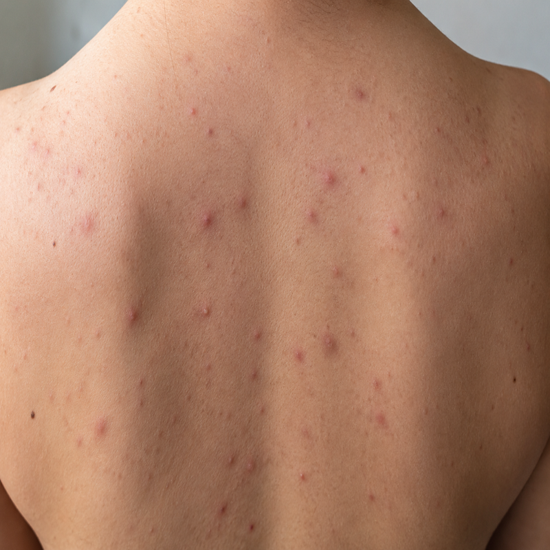 close up of back acne