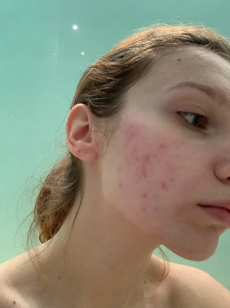 woman with acne on her face