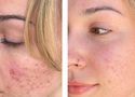 Does Azelaic Acid Help With Acne Scars?