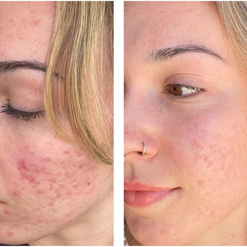 Before and after using Azealic acid for scars