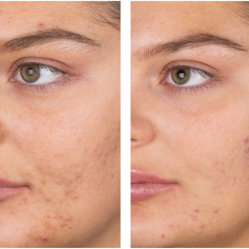 Before and after using salicylic for scars