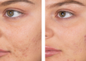 Salicylic Acid for Acne Scars: Does It Really Work?