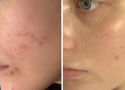 How to Get Rid of Acne Scars Naturally