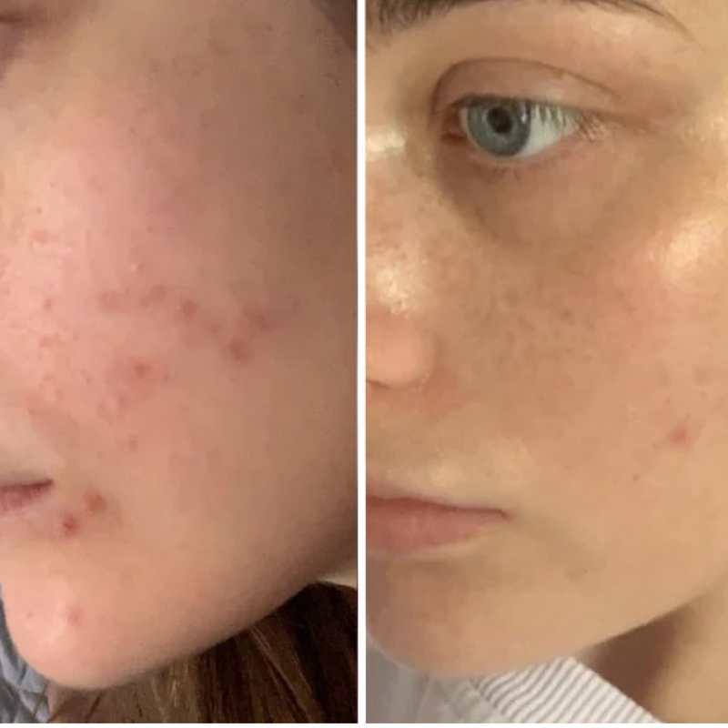 before and after of acne scars
