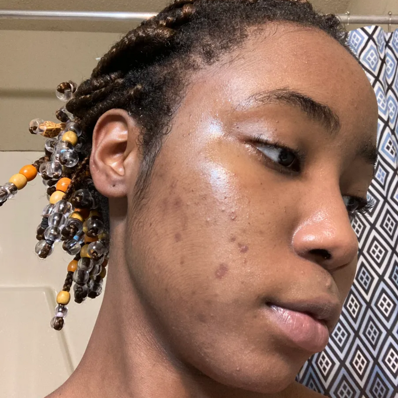 woman with acne on her face