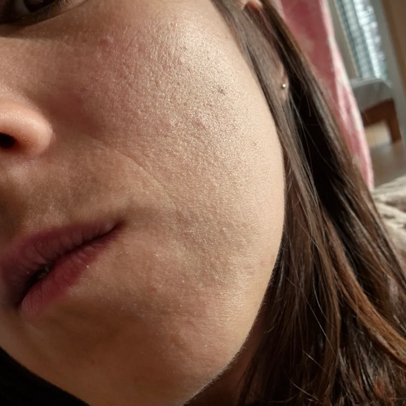 uneven skin texture on cheek