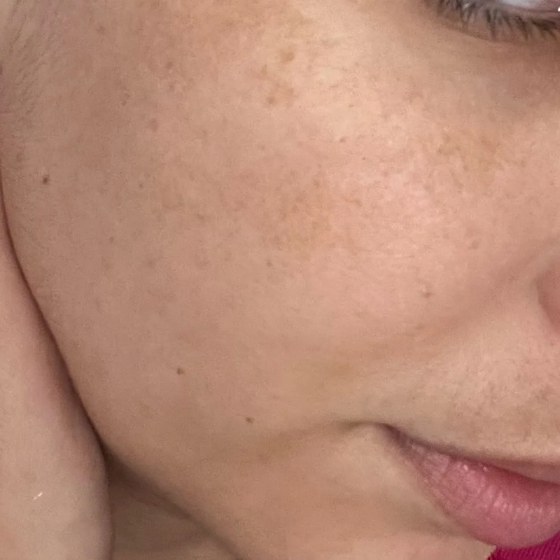 close up of hyperpigmentation