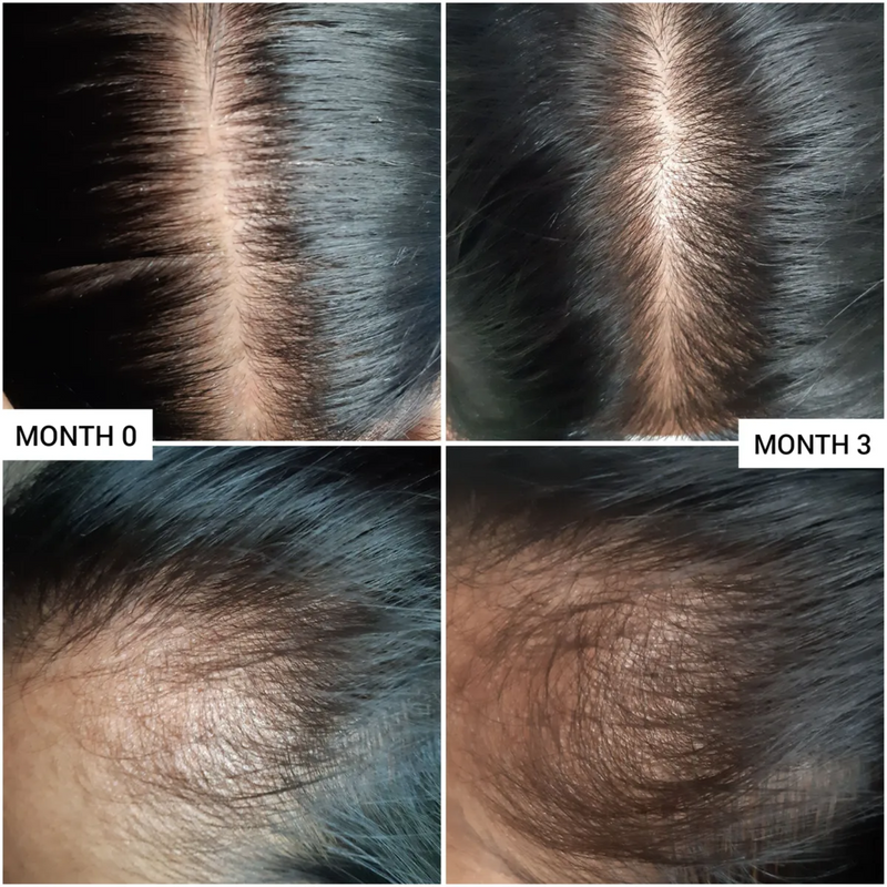 Before and after using Caffeien scalp treatment