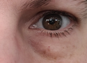 How to Get Rid of Bags Under Eyes: Causes, Treatments and What Actually Works
