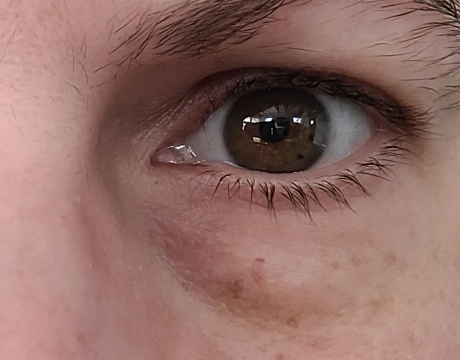 under eye bags