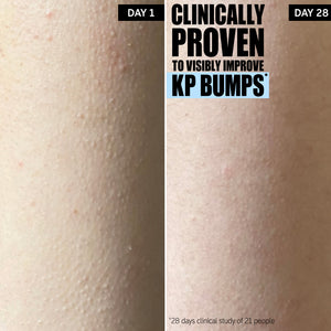 Clinically proven to visibly improve KP Bumps*. Progression after 28 days.