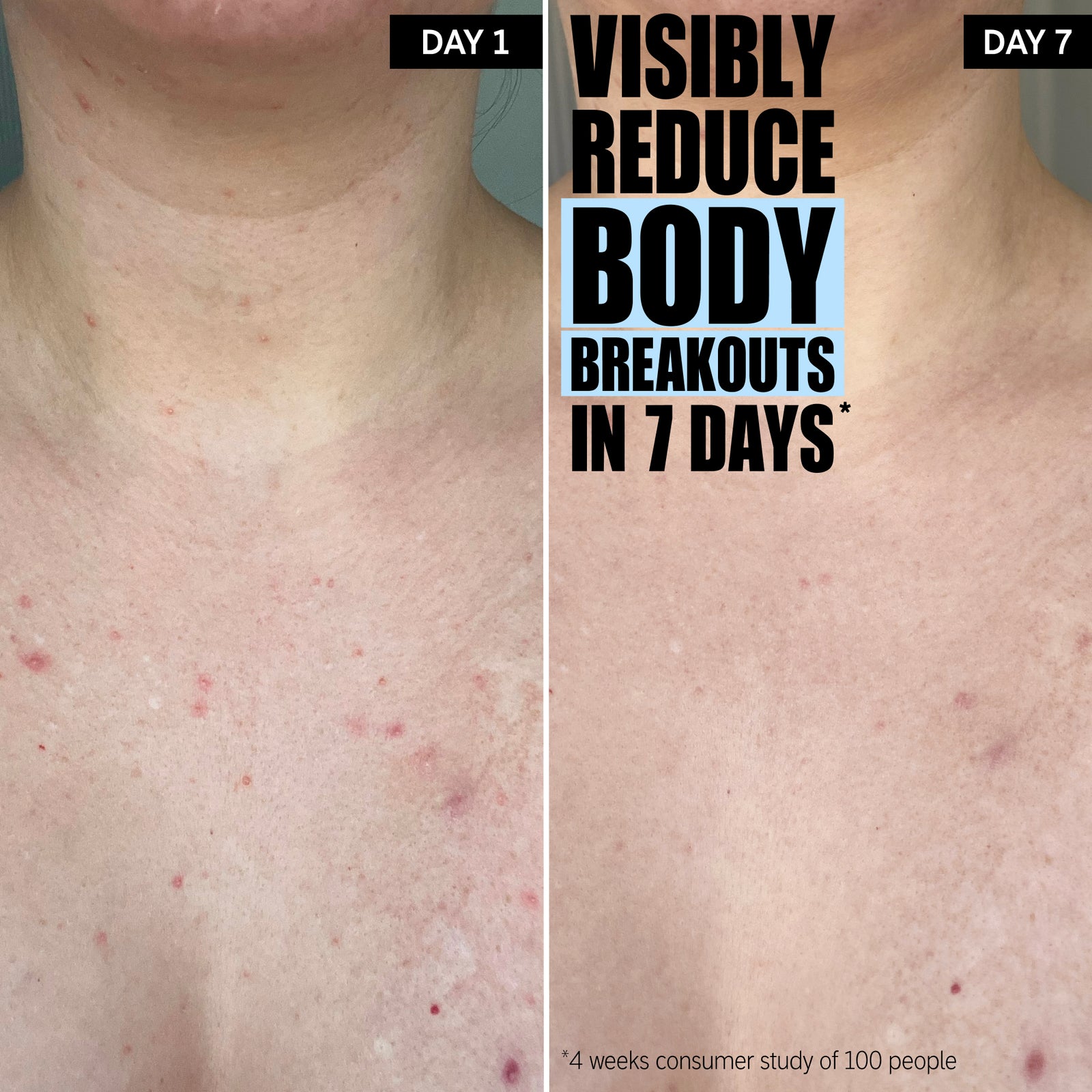 Visibly reduce body breakouts in 7 days*. The difference with 7 days use.
