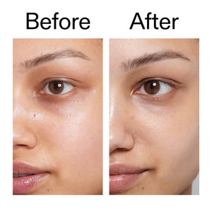 Before and after comparison of a person's face with visible skin improvement.