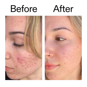 10% Azelaic Acid Serum - Anti Redness Formula | The INKEY List USA