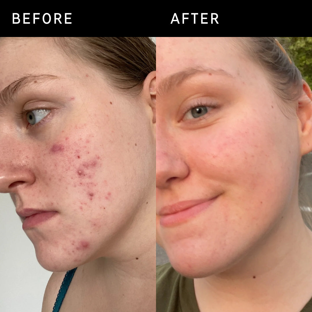 Before and after using 15% Vitamin C + EGF Serum