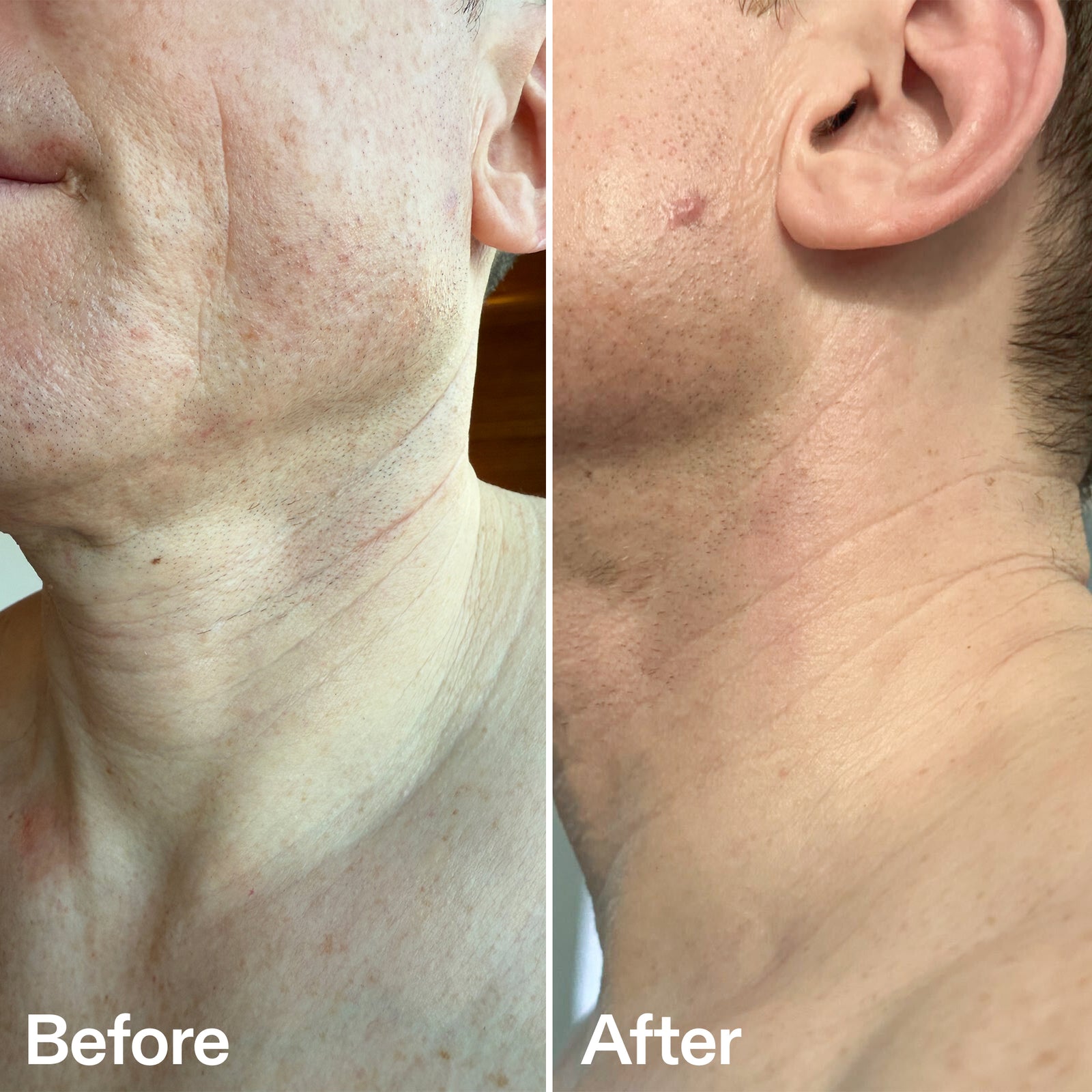 Before and after comparison of neck skin texture on a person.