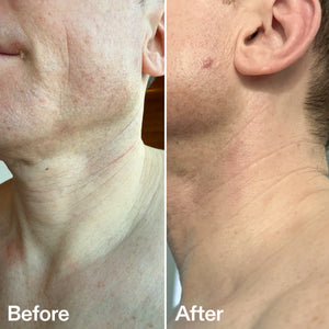 Before and after comparison of neck skin texture on a person.