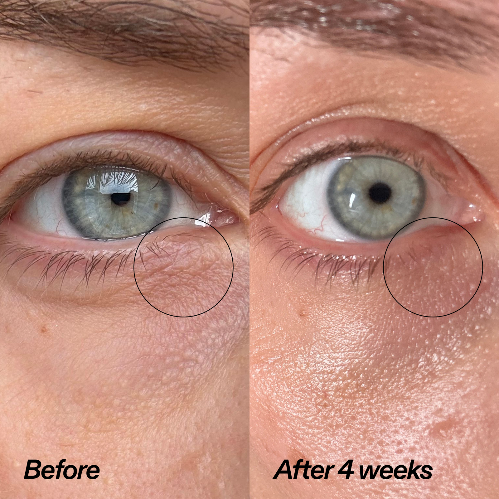 Side-by-side close-up of a human eye labeled 'Before' and 'After 4 weeks' with a circled under-eye area, showing skin texture improvement over time.