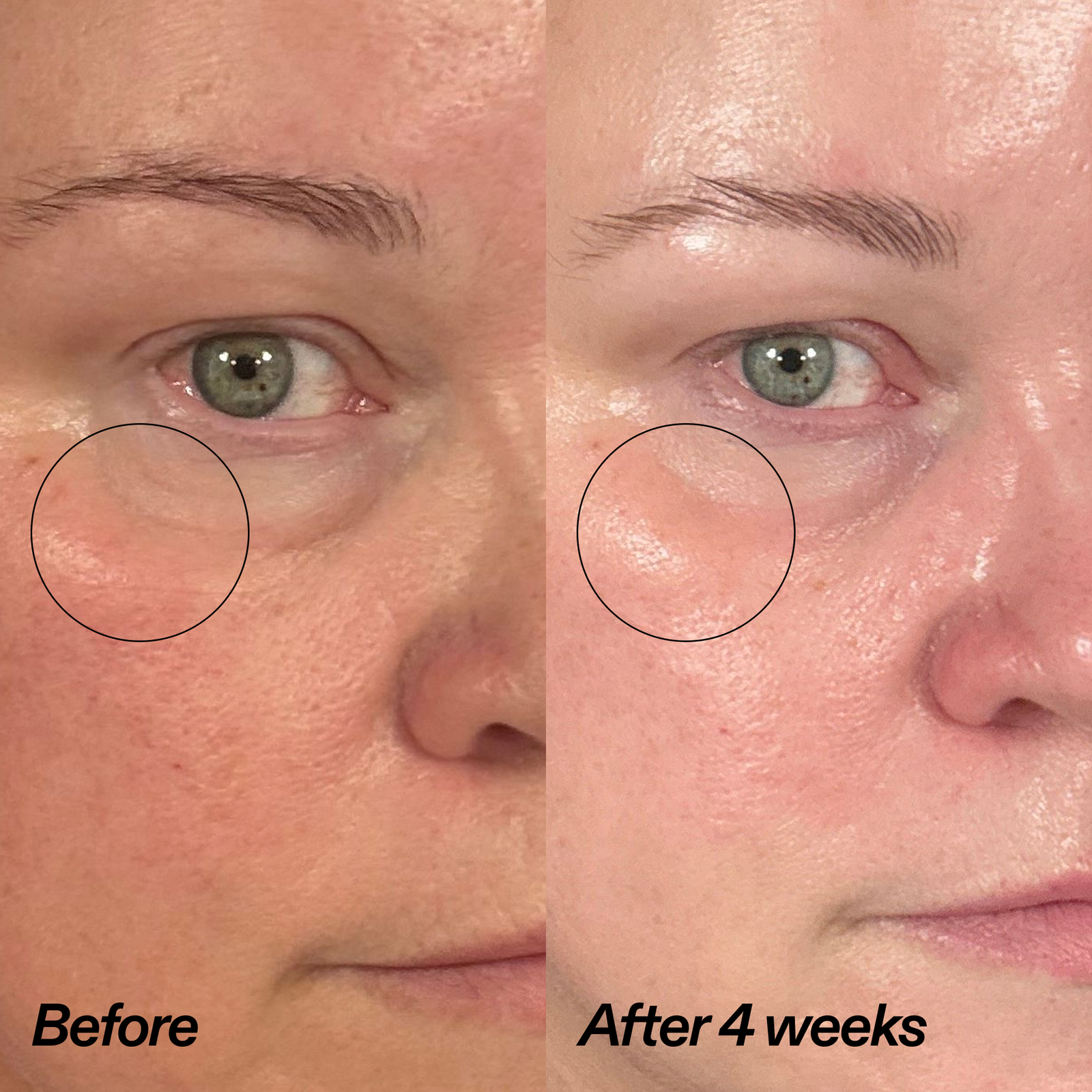 Close-up before-and-after comparison of a person's under-eye area, labeled 'Before' and 'After 4 weeks,' showing a visible reduction in dark circles and puffiness.