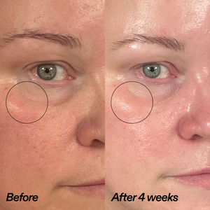 Close-up before-and-after comparison of a person's under-eye area, labeled 'Before' and 'After 4 weeks,' showing a visible reduction in dark circles and puffiness.