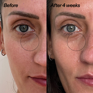 A split-screen before-and-after comparison of a woman's eye area, labeled 'Before' on the left and 'After 4 weeks' on the right, with a black circle highlighting the under-eye region.