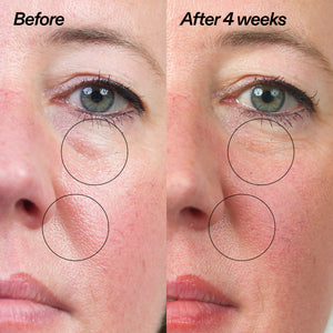 Before and after comparison of a woman's face with circles highlighting areas of improvement.
