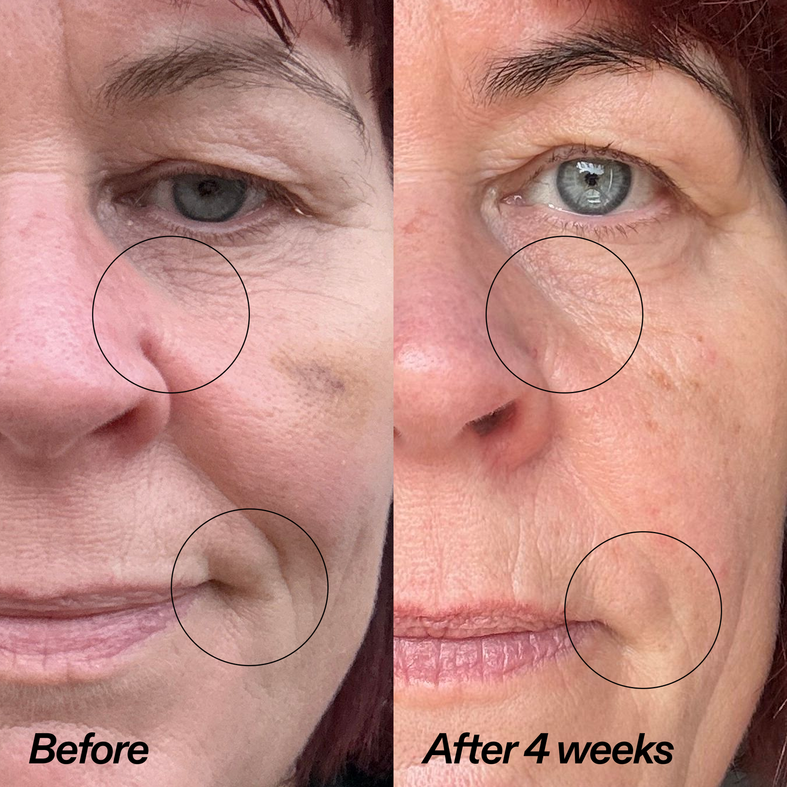 Before-and-after facial comparison of a woman's face, showing skin around the eyes and mouth with circled areas highlighting wrinkles. The left side is labeled 'Before' and the right side is labeled 'After 4 weeks'.