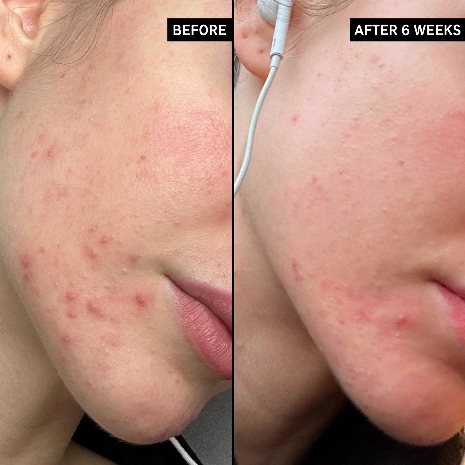 Before and after pictures of someone using Acne Clearing Moisturizer after 6 weeks