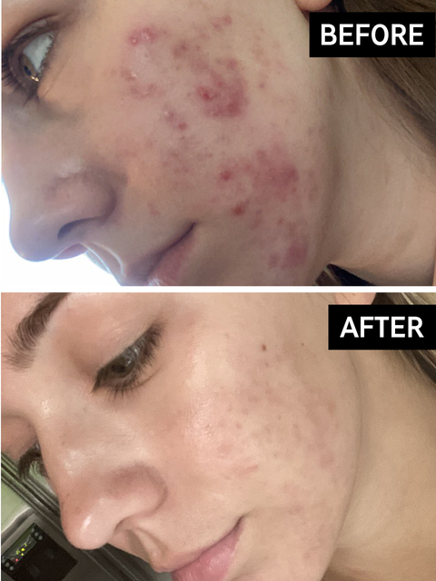 Before and after image of a customer who used Omega Water Cream