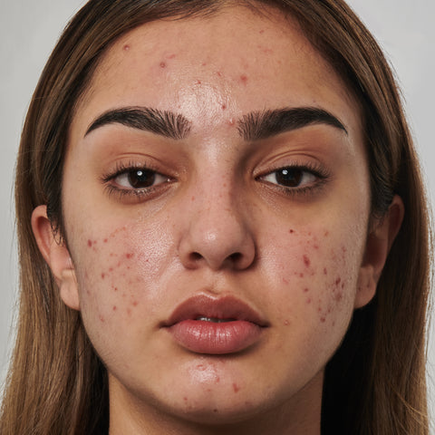 Model with Acne looking into the camera