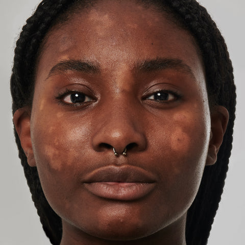 Model with dry, flakey skin