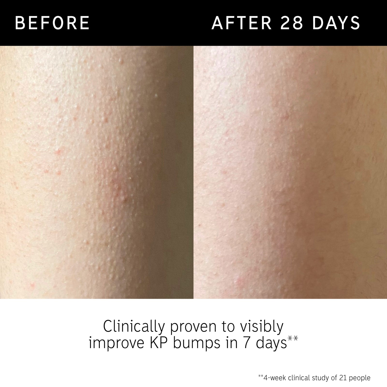 Before and after of using Glycolic Acid Body Stick and key claim from recent clinical study