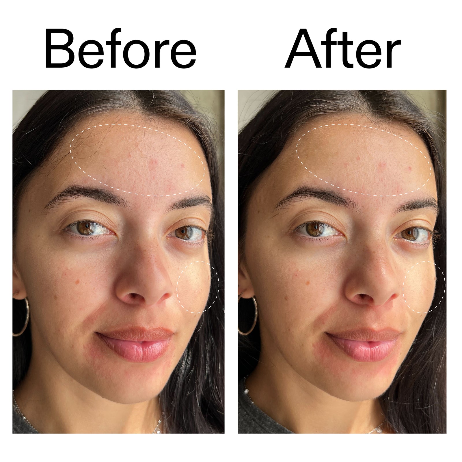 Before and after comparison of a woman's face with visible improvements using Glyercin Cleanser