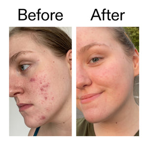 Before and after comparison of a person's face with visible acne on the left, and clearer skin on the right.