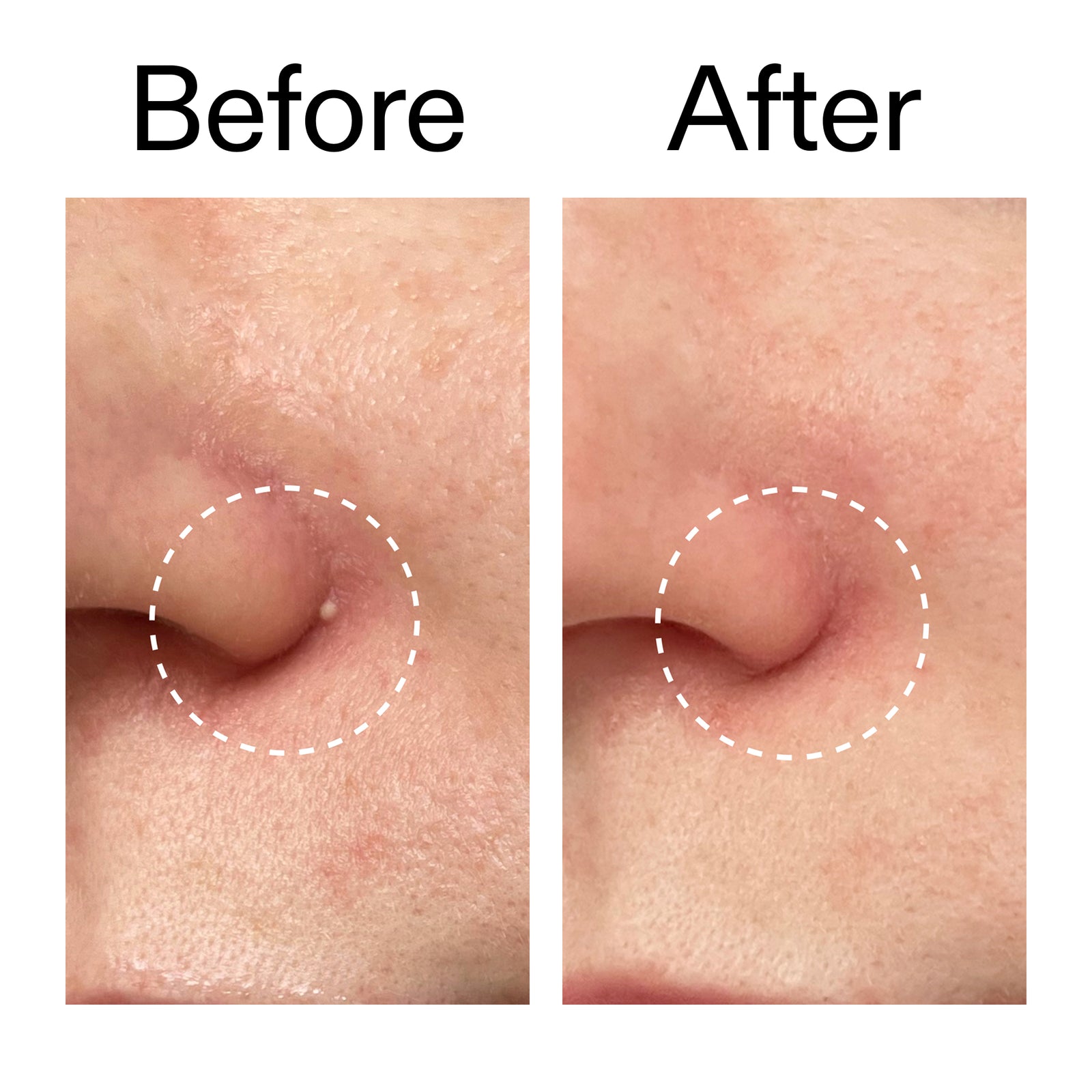 Before and after comparison of skin texture on a person's cheek.