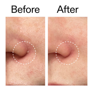 Before and after comparison of skin texture on a person's cheek.