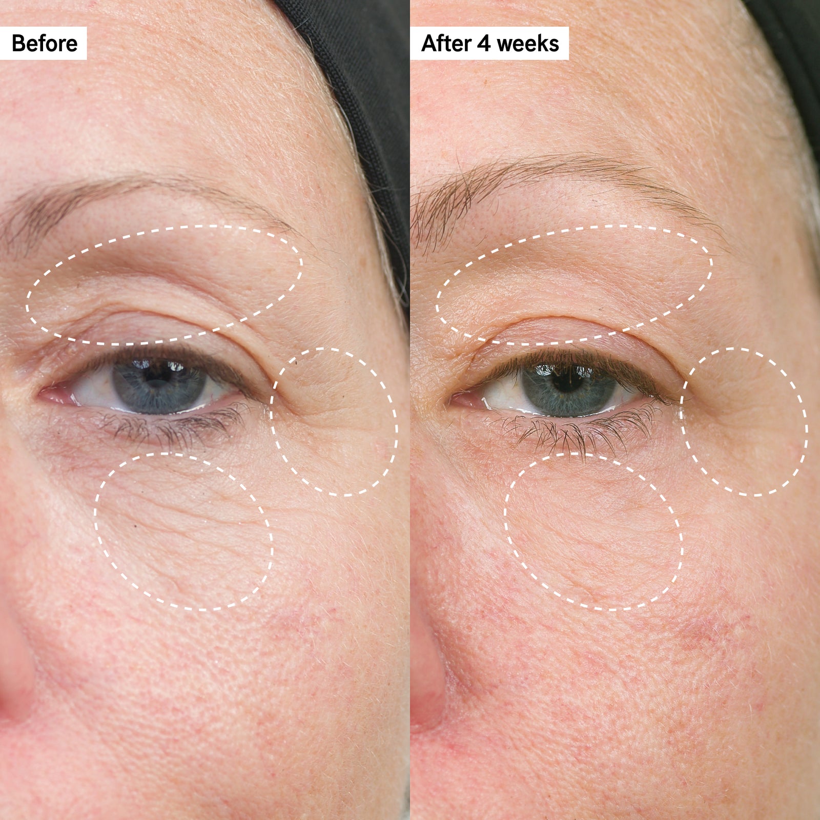 Before and after showing significant eye wrinkle reduction