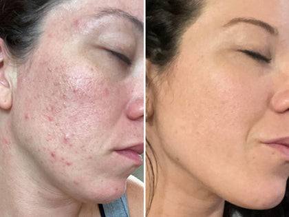 Before and after images of a customer to show how The INKEY List products cleared her blemishes.