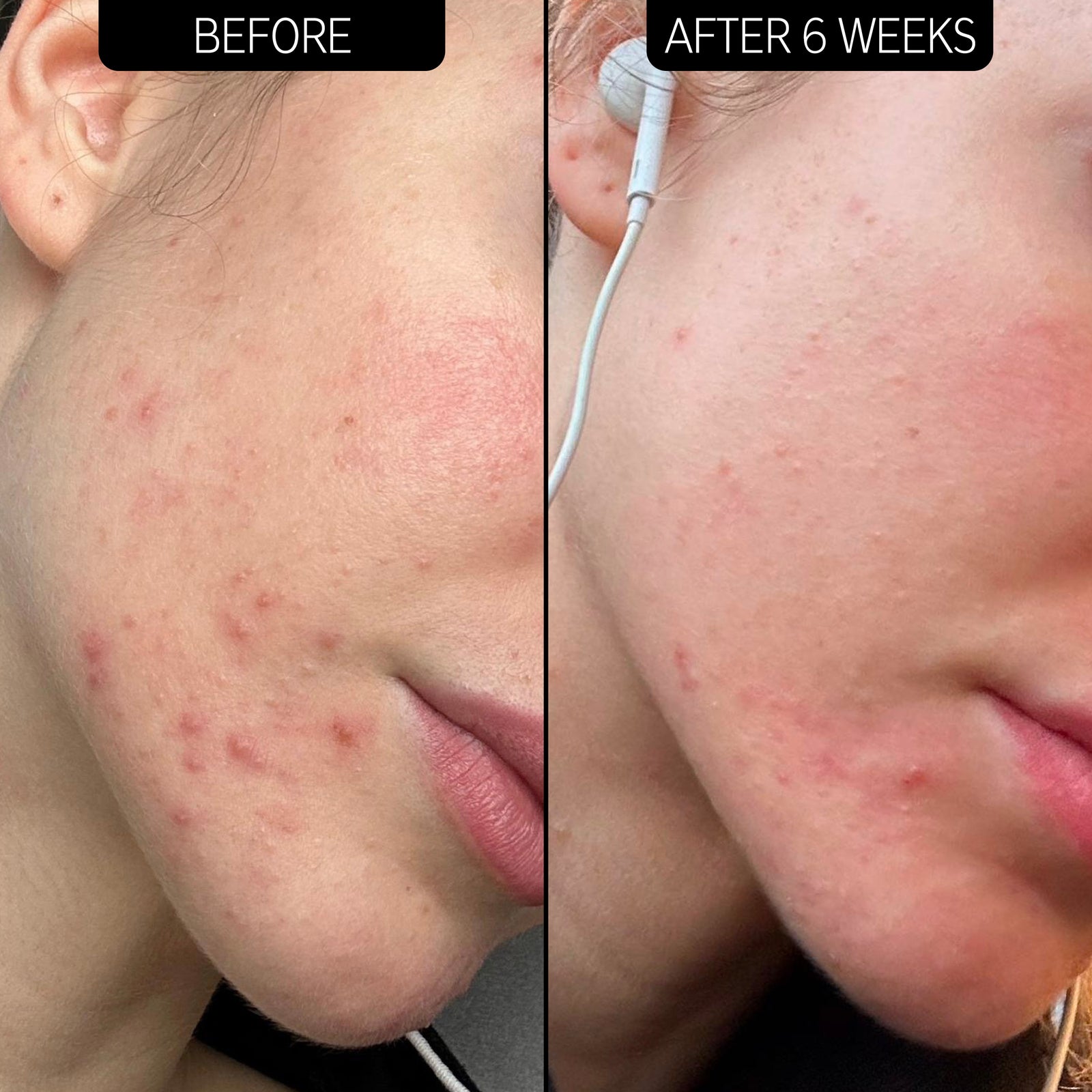 Before and after using Acne Solution Trio 6 weeks results displaying visible acne reduction