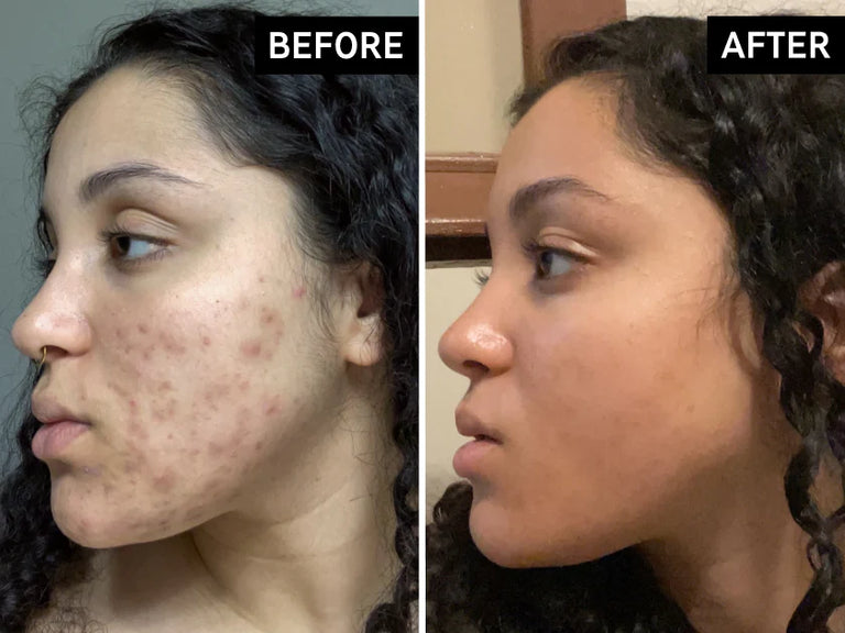 Before and after comparison of a person's face with acne on the left side and clear skin on the right side.