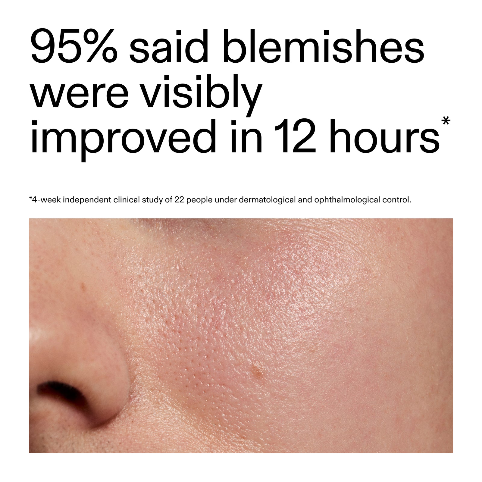 Advertisement showing a close-up of skin with blemishes and text about improvement in 12 hours after using Succinic Acid Acne Treatment