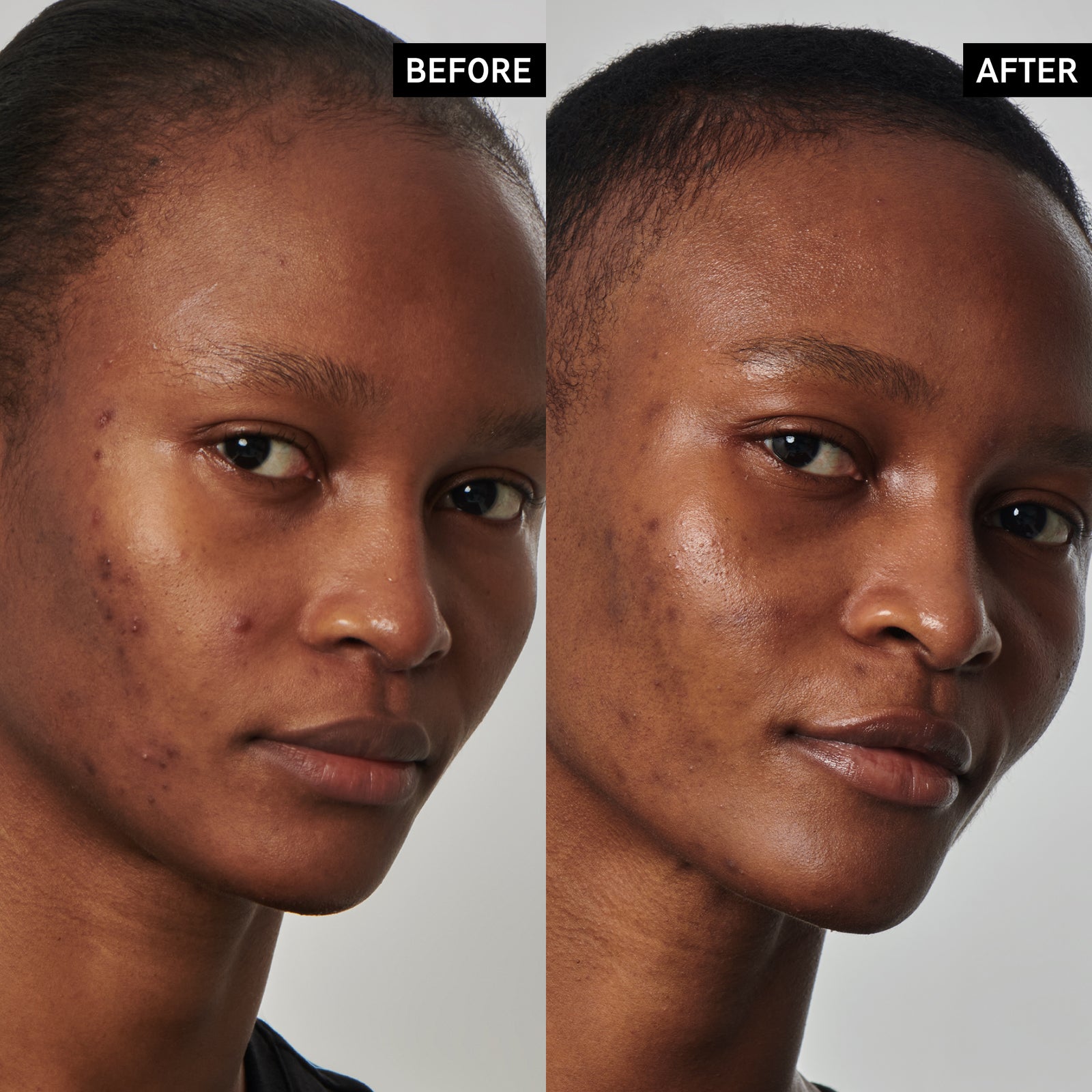 Excess Oil Solution with 20% Niacinamide Serum | The INKEY List