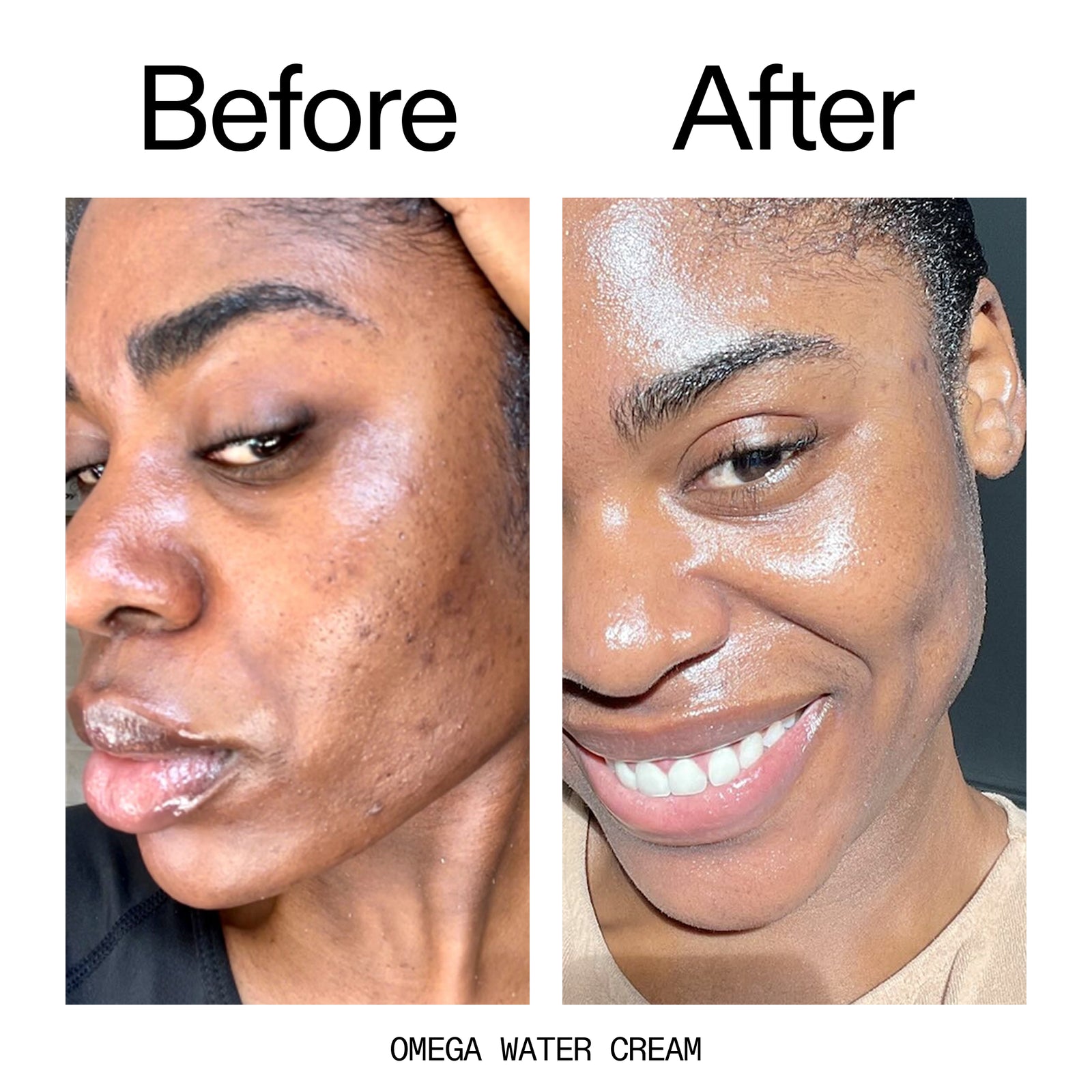 Before and after comparison of a person's face with Omega Water Cream.