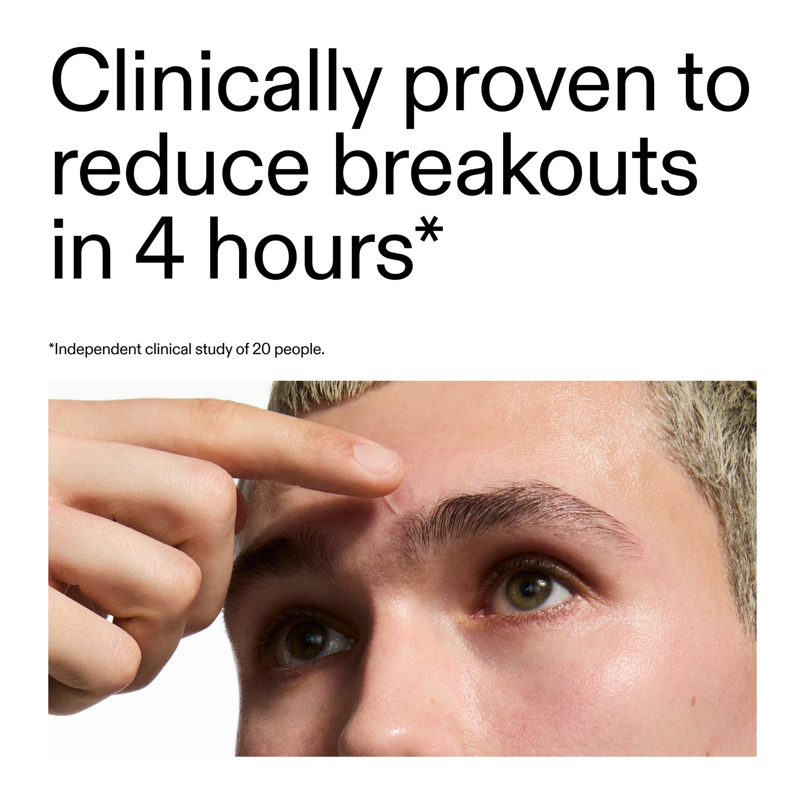 close-up of a person's face with text claiming Hydrocolloid Invisible Pimple Patches to clinically reduce breakouts in 4 hours.